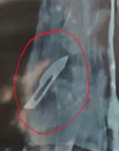 पीबीएम ट्रॉमा सेंटर में बड़ी लापरवाही, बच्चे के पैर के प्लास्टर में छूटी सर्जिकल ब्लेड